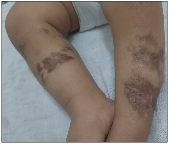 Multiple ill-defined irregular hyperpigmented atrophic scarring with areas of depigmentation present over sites of healing. (After 4 months of maintenance therapy – 1 year and 2 months of age).